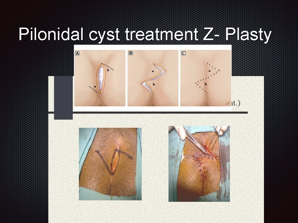 Pilonidal cyst treatment Z- Plasty 