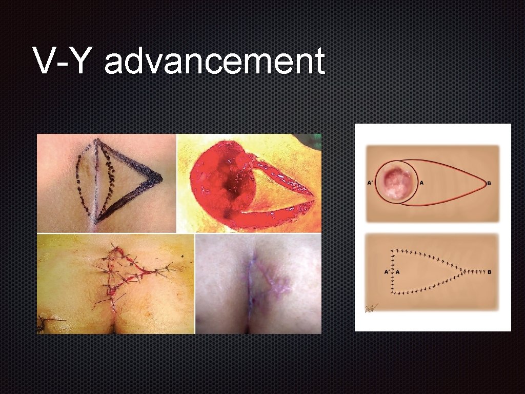 V-Y advancement 
