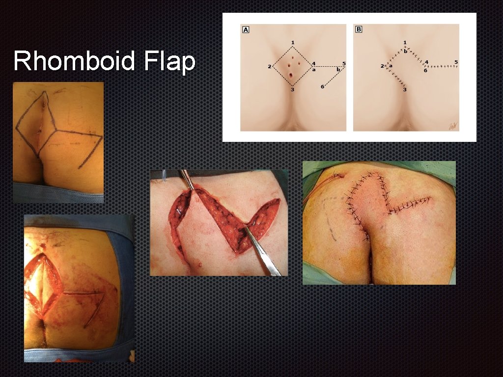 Rhomboid Flap 