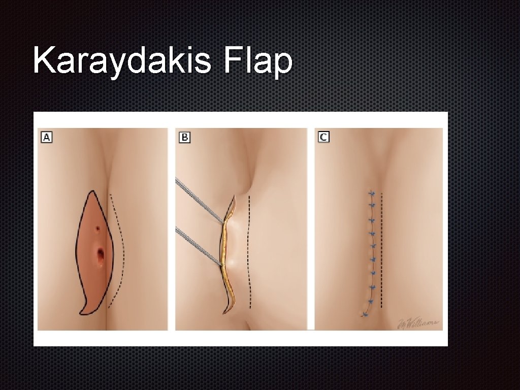 Karaydakis Flap 