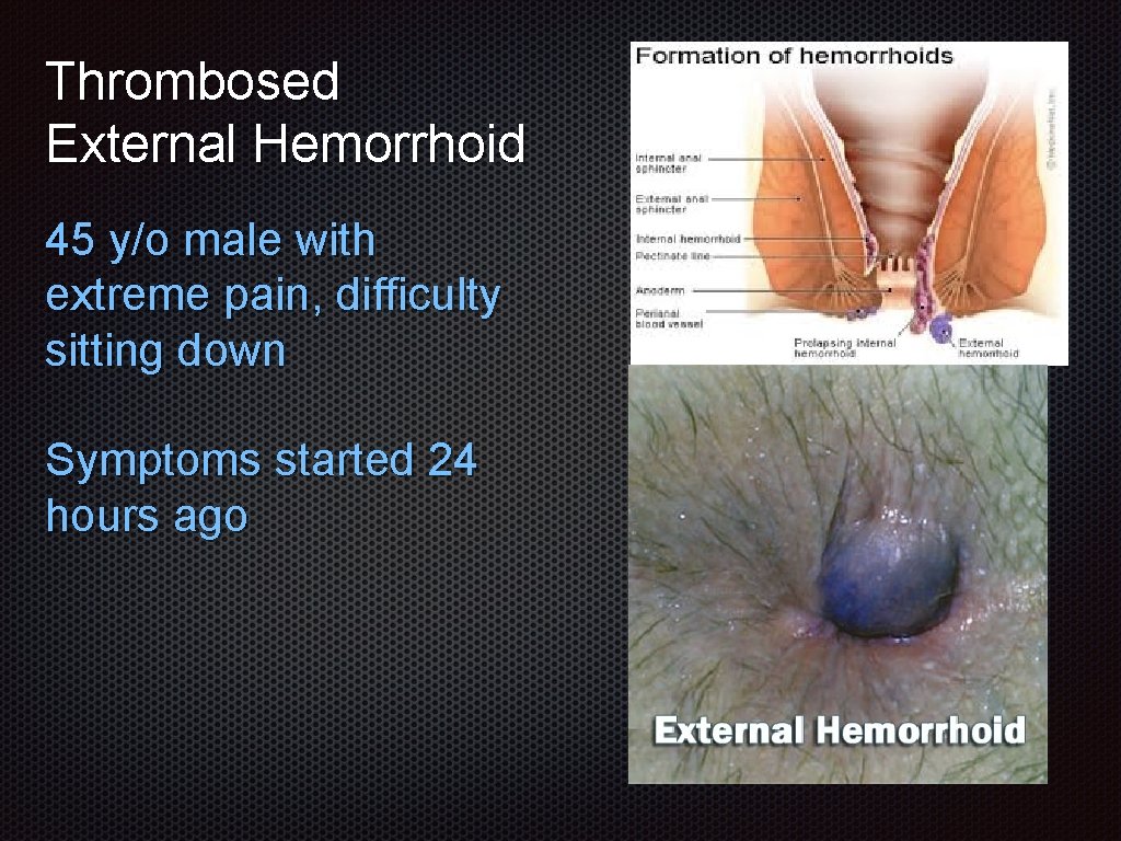 Thrombosed External Hemorrhoid 45 y/o male with extreme pain, difficulty sitting down Symptoms started