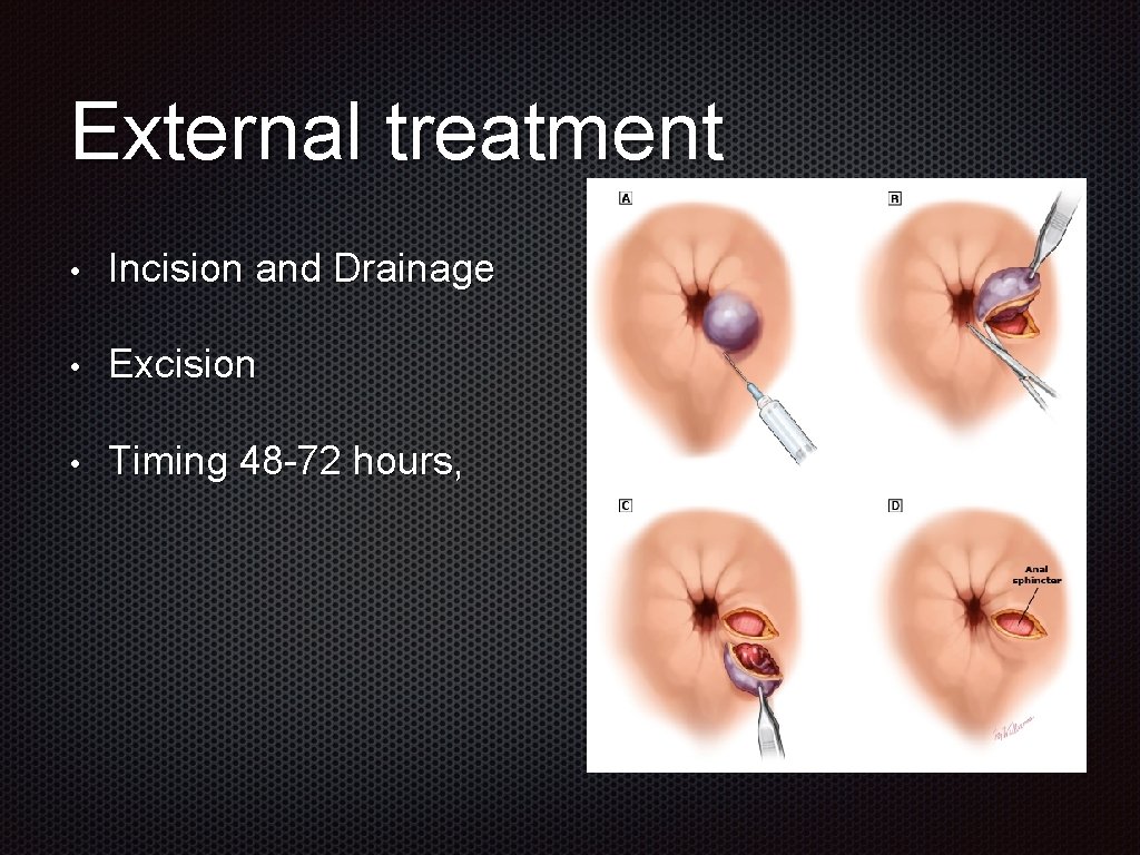 External treatment • Incision and Drainage • Excision • Timing 48 -72 hours, 