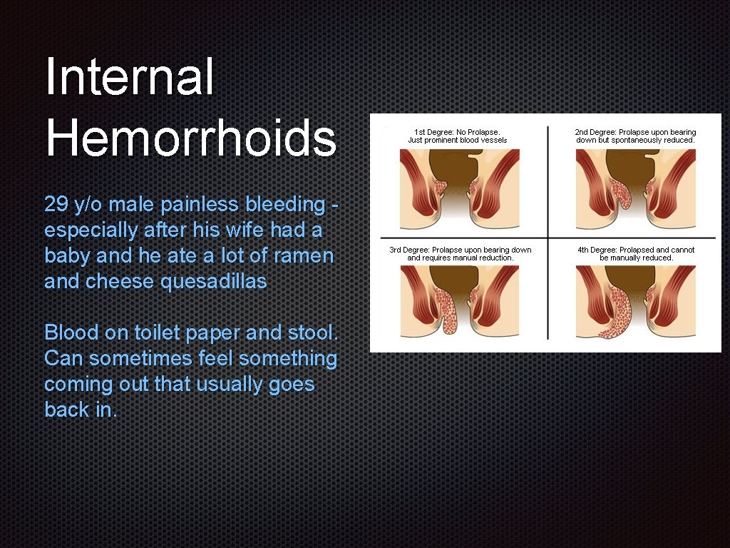 Internal Hemorrhoids 29 y/o male painless bleeding especially after his wife had a baby