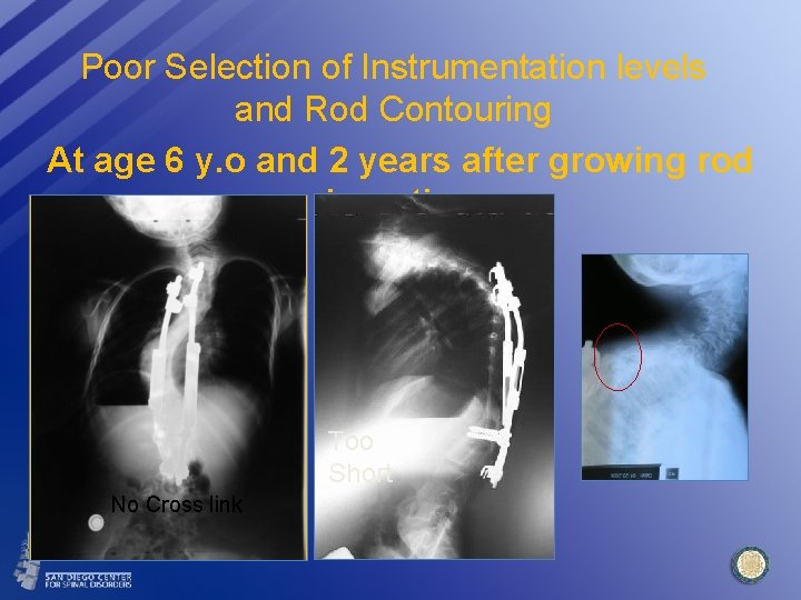 Poor Selection of Instrumentation levels and Rod Contouring At age 6 y. o and