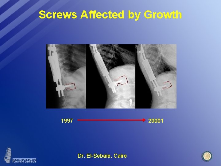 Screws Affected by Growth 1997 20001 Dr. El-Sebaie, Cairo 