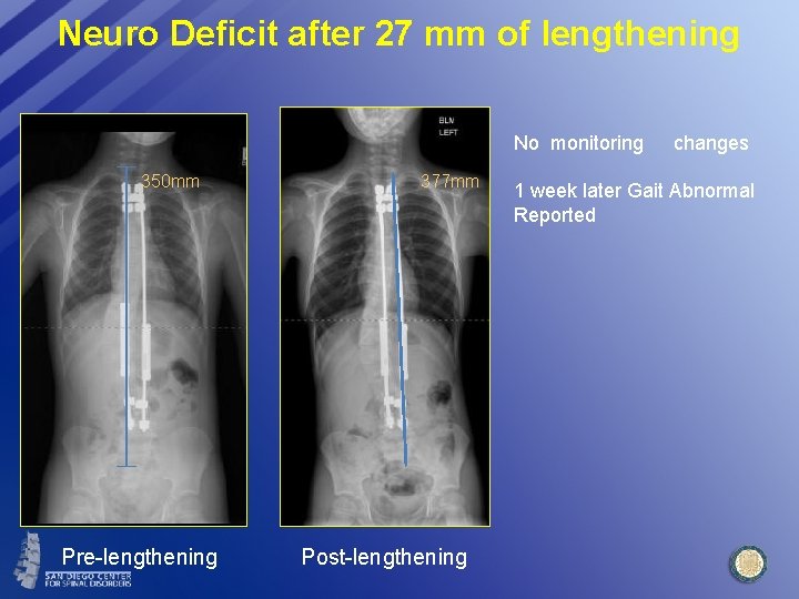 Neuro Deficit after 27 mm of lengthening No monitoring 350 mm Pre-lengthening 377 mm