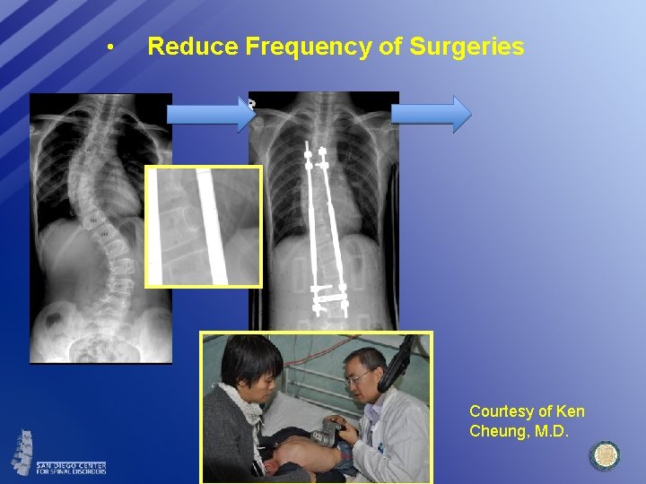  • Reduce Frequency of Surgeries Courtesy of Ken Cheung, M. D. 