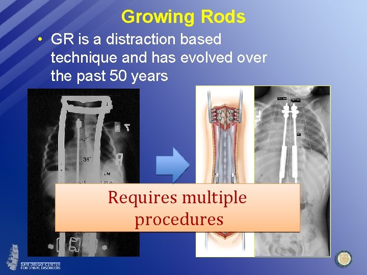 Growing Rods • GR is a distraction based technique and has evolved over the