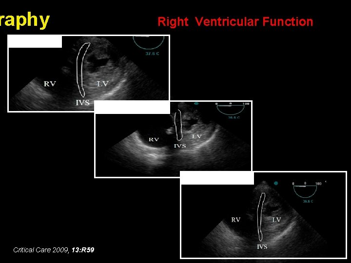 raphy Right Ventricular Function Baseline Recruitment Open lung PEEP Critical Care 2009, 13: R