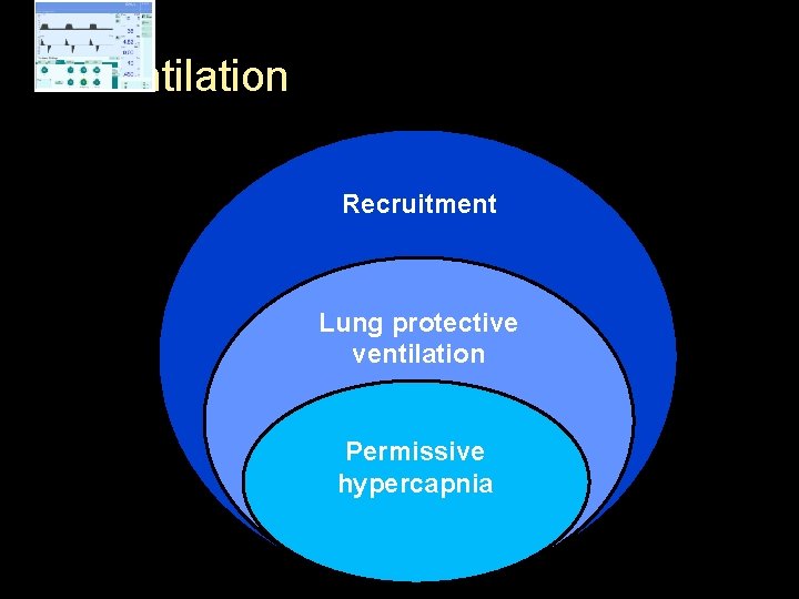 Ventilation Recruitment Lung protective ventilation Permissive hypercapnia 