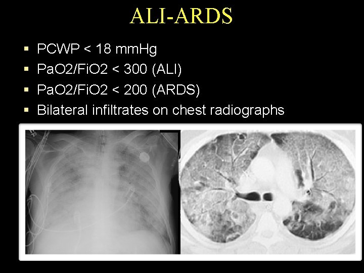 ALI-ARDS § PCWP < 18 mm. Hg § Pa. O 2/Fi. O 2 <