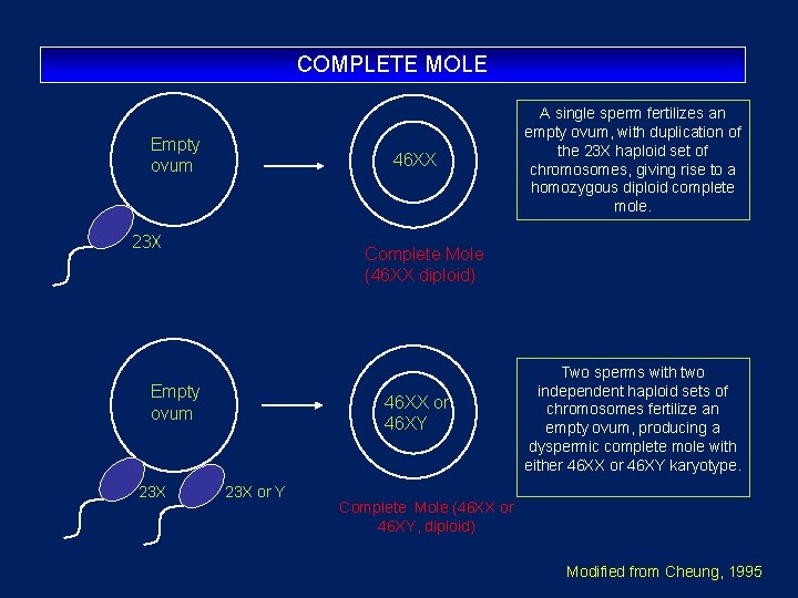 COMPLETE MOLE Empty ovum 46 XX 23 X Complete Mole (46 XX diploid) Empty