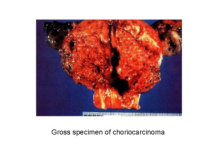 Gross specimen of choriocarcinoma 