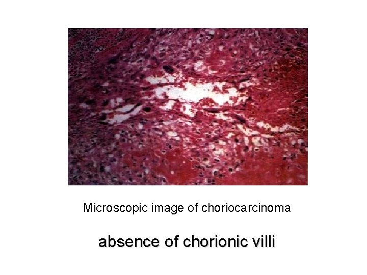 Microscopic image of choriocarcinoma absence of chorionic villi 