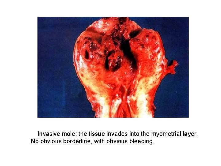 Invasive mole: the tissue invades into the myometrial layer. No obvious borderline, with obvious
