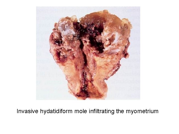 Invasive hydatidiform mole infiltrating the myometrium 