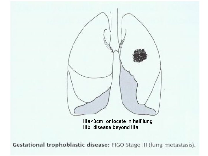 IIIa<3 cm or locate in half lung IIIb disease beyond IIIa 