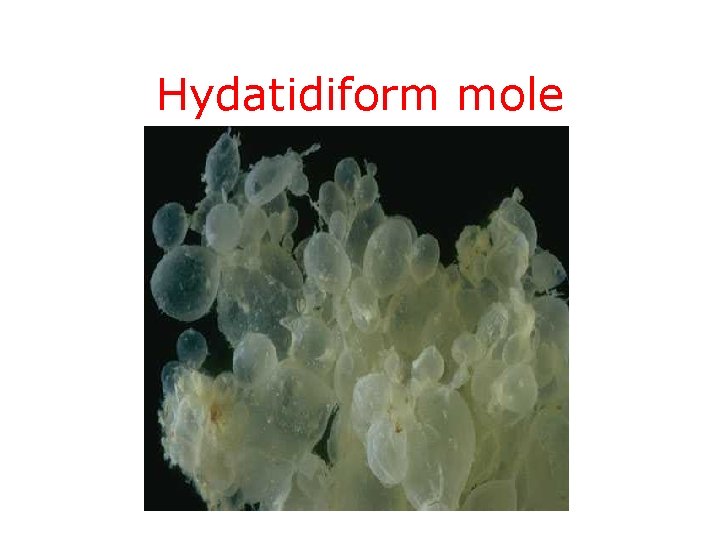 Hydatidiform mole 