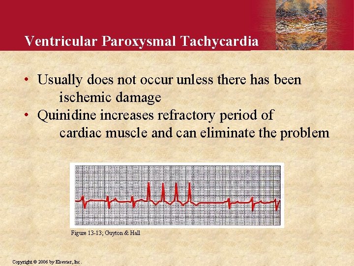 Ventricular Paroxysmal Tachycardia • Usually does not occur unless there has been ischemic damage