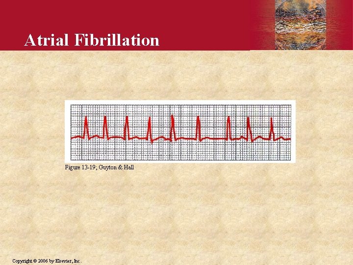 Atrial Fibrillation Figure 13 -19; Guyton & Hall Copyright © 2006 by Elsevier, Inc.