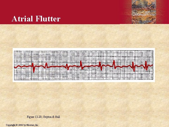 Atrial Flutter Figure 13 -20; Guyton & Hall Copyright © 2006 by Elsevier, Inc.