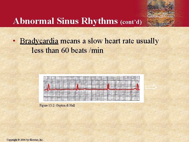 Abnormal Sinus Rhythms (cont’d) • Bradycardia means a slow heart rate usually less than