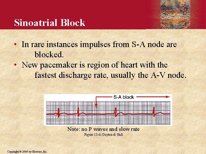 Sinoatrial Block • In rare instances impulses from S-A node are blocked. • New