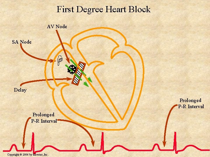 First Degree Heart Block AV Node SA Node H T Delay Prolonged P-R Interval