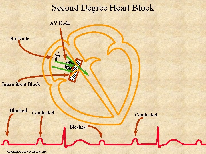 Second Degree Heart Block AV Node SA Node H T Intermittent Blocked Conducted Blocked