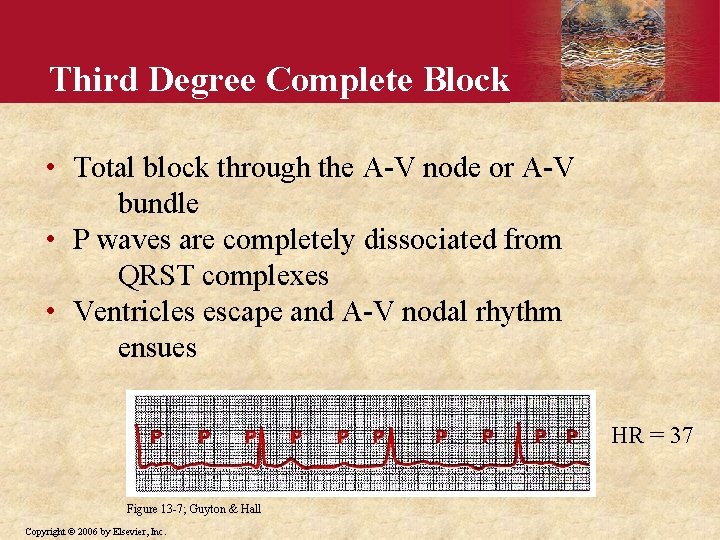 Third Degree Complete Block • Total block through the A-V node or A-V bundle