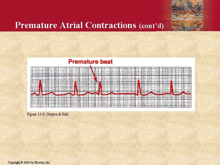 Premature Atrial Contractions Figure 13 -9; Guyton & Hall Copyright © 2006 by Elsevier,