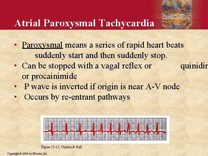 Atrial Paroxysmal Tachycardia • Paroxysmal means a series of rapid heart beats suddenly start