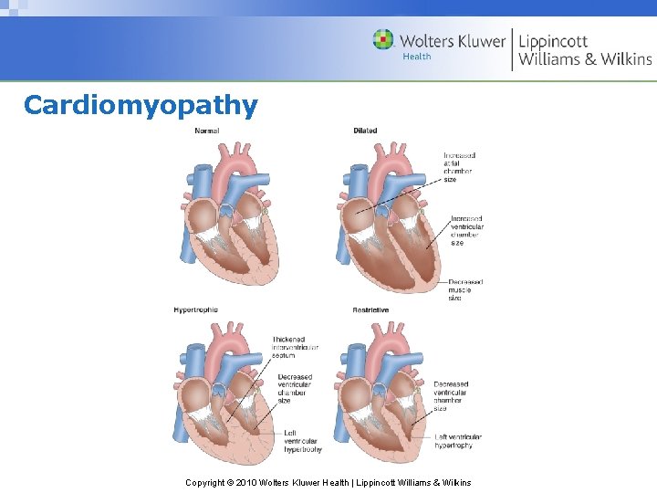 Cardiomyopathy Copyright © 2010 Wolters Kluwer Health | Lippincott Williams & Wilkins 