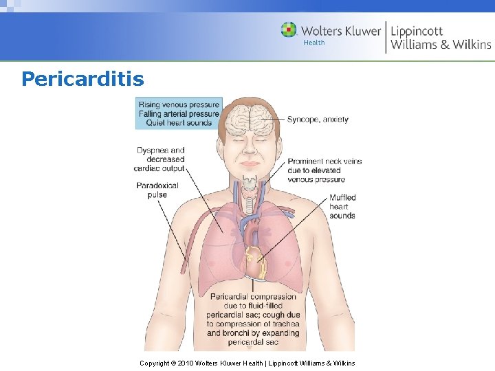 Pericarditis Copyright © 2010 Wolters Kluwer Health | Lippincott Williams & Wilkins 