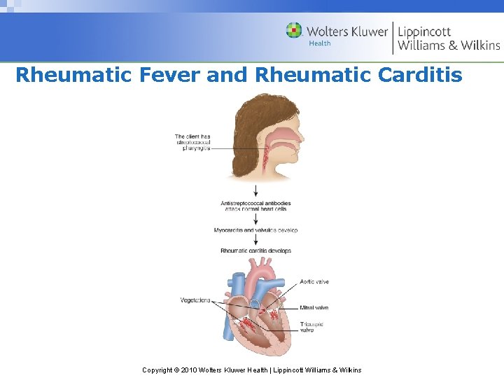 Rheumatic Fever and Rheumatic Carditis Copyright © 2010 Wolters Kluwer Health | Lippincott Williams