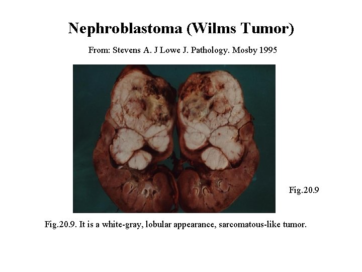 Nephroblastoma (Wilms Tumor) From: Stevens A. J Lowe J. Pathology. Mosby 1995 Fig. 20.