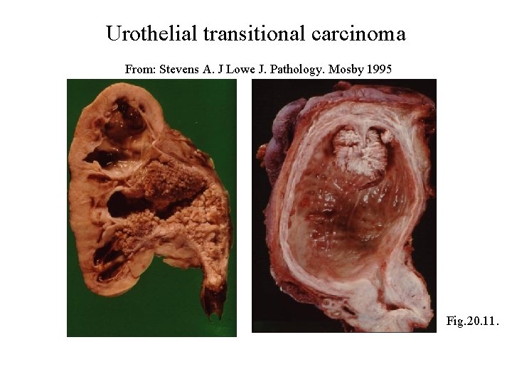 Urothelial transitional carcinoma From: Stevens A. J Lowe J. Pathology. Mosby 1995 Fig. 20.