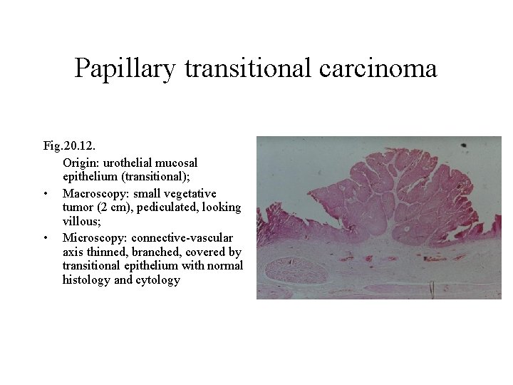 Papillary transitional carcinoma Fig. 20. 12. Origin: urothelial mucosal epithelium (transitional); • Macroscopy: small