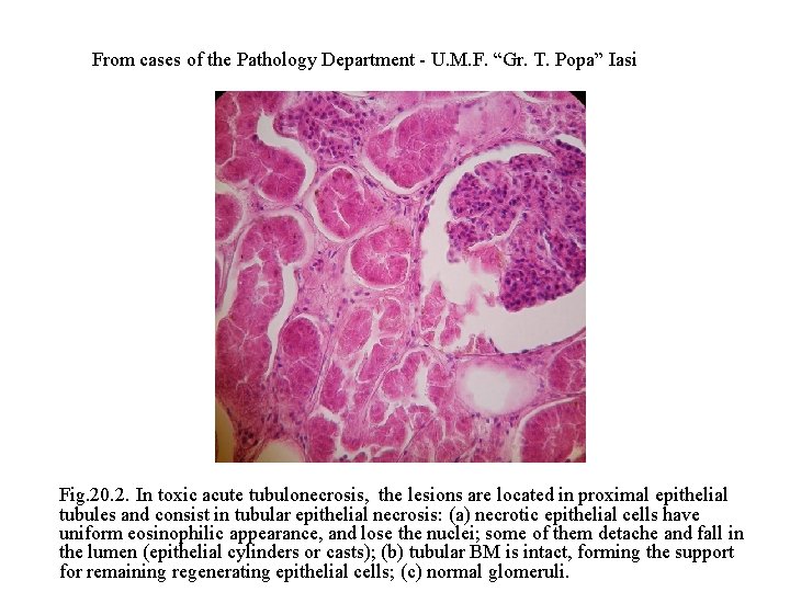 From cases of the Pathology Department - U. M. F. “Gr. T. Popa” Iasi