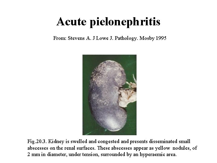 Acute pielonephritis From: Stevens A. J Lowe J. Pathology. Mosby 1995 Fig. 20. 3.