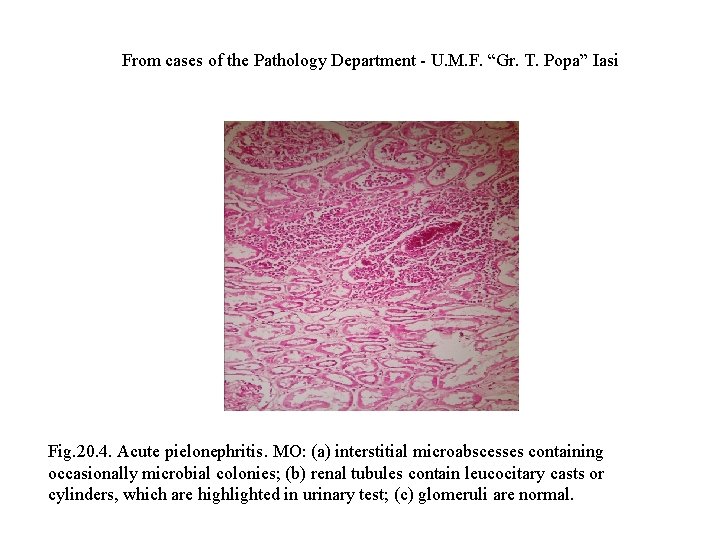 From cases of the Pathology Department - U. M. F. “Gr. T. Popa” Iasi