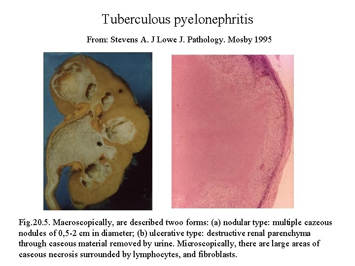 Tuberculous pyelonephritis From: Stevens A. J Lowe J. Pathology. Mosby 1995 Fig. 20. 5.