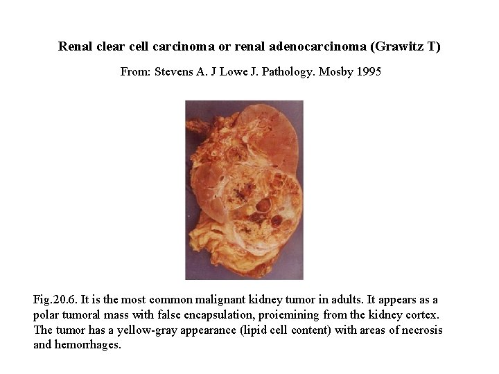 Renal clear cell carcinoma or renal adenocarcinoma (Grawitz T) From: Stevens A. J Lowe