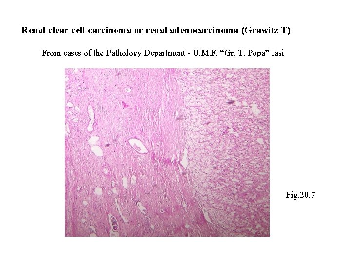 Renal clear cell carcinoma or renal adenocarcinoma (Grawitz T) From cases of the Pathology