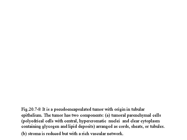 Fig. 20. 7 -8 It is a pseudoencapsulated tumor with origin in tubular epithelium.