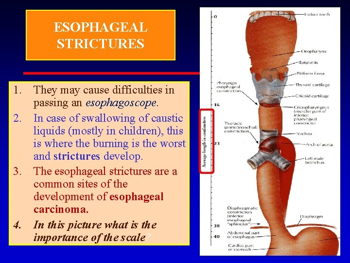 ESOPHAGEAL STRICTURES 1. They may cause difficulties in passing an esophagoscope. 2. In case