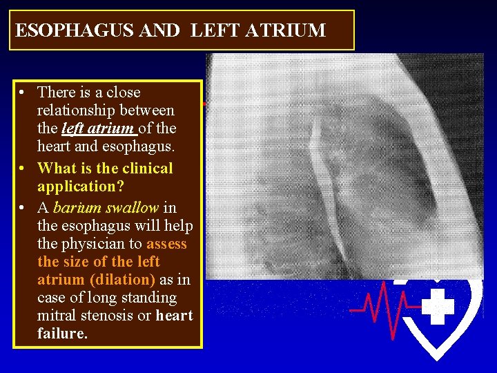 ESOPHAGUS AND LEFT ATRIUM • There is a close relationship between the left atrium