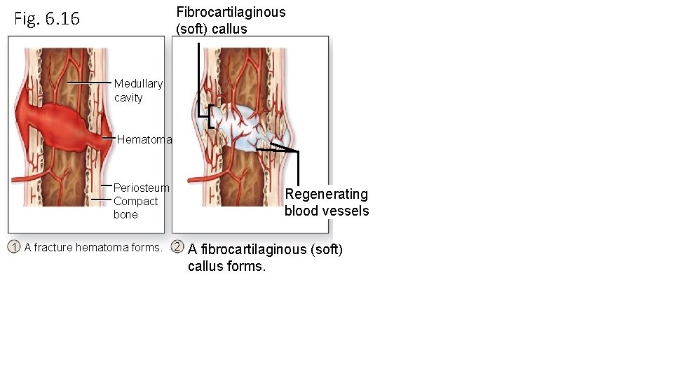 Fibrocartilaginous (soft) callus Fig. 6. 16 Medullary cavity Hematoma Periosteum Compact bone 1 A