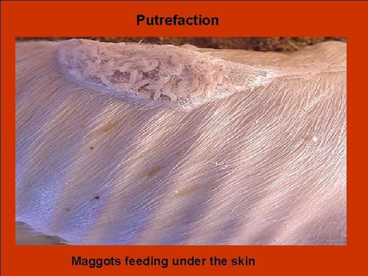 Putrefaction Maggots feeding under the skin 