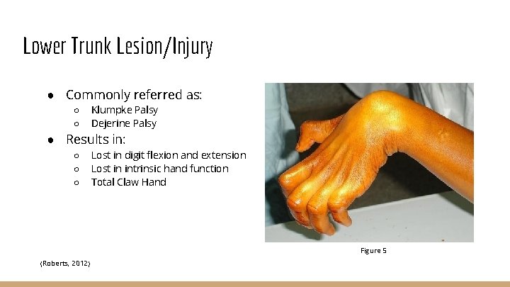 Lower Trunk Lesion/Injury ● Commonly referred as: ○ ○ Klumpke Palsy Dejerine Palsy ●